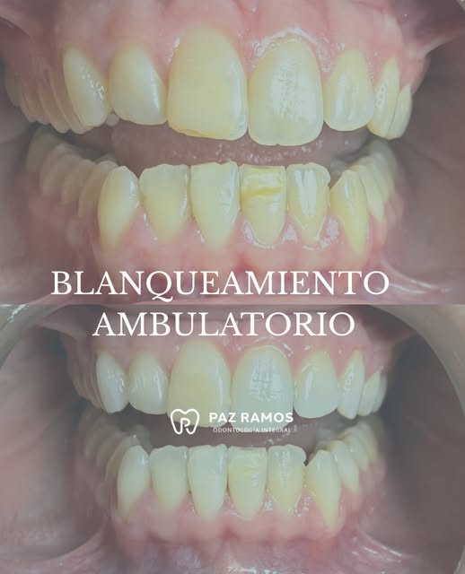 Caso de blanqueamiento y armonía dental terminada